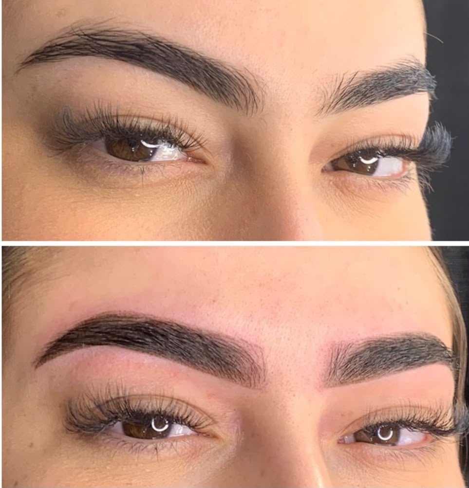 Antes e depois — Preenchimento